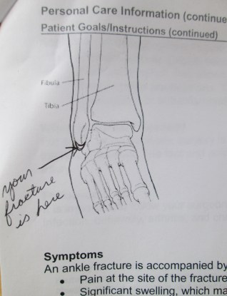 Broken ankle treatment summary 1-2015